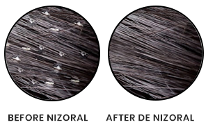 result-nizoral